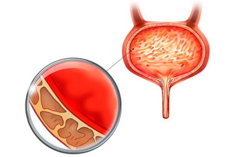 Inflammation of the mucous membrane of the urinary bladder with cystitis